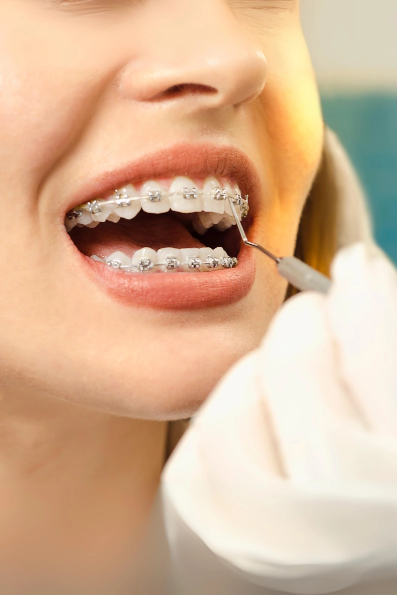 Orthodontics Braces in Dubai at the best price. Visit our dental clinic in Jumeirah & DFC Dubai UAE.